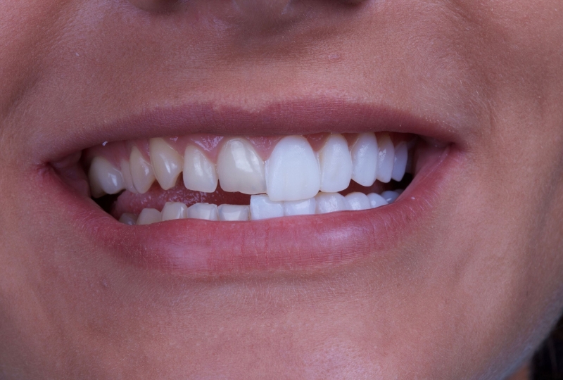Caring For Your New Veneers 5 Must-Know Tips
