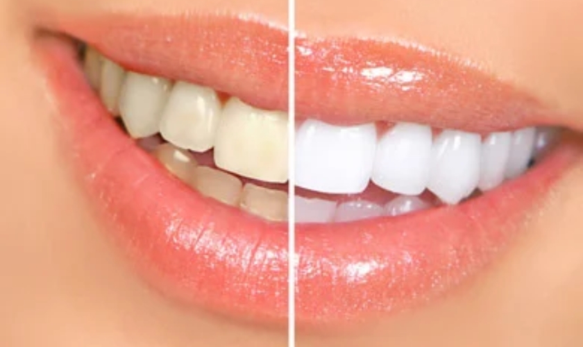 Should I Brush My Teeth After Using Whitening Strips